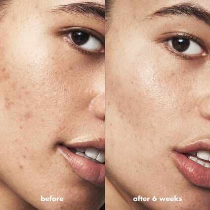 Blemish Control Basics Kit